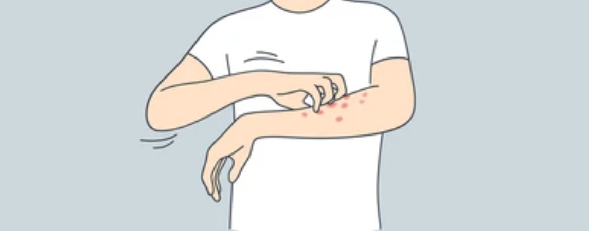 Atopik Dermatit Tedavisi